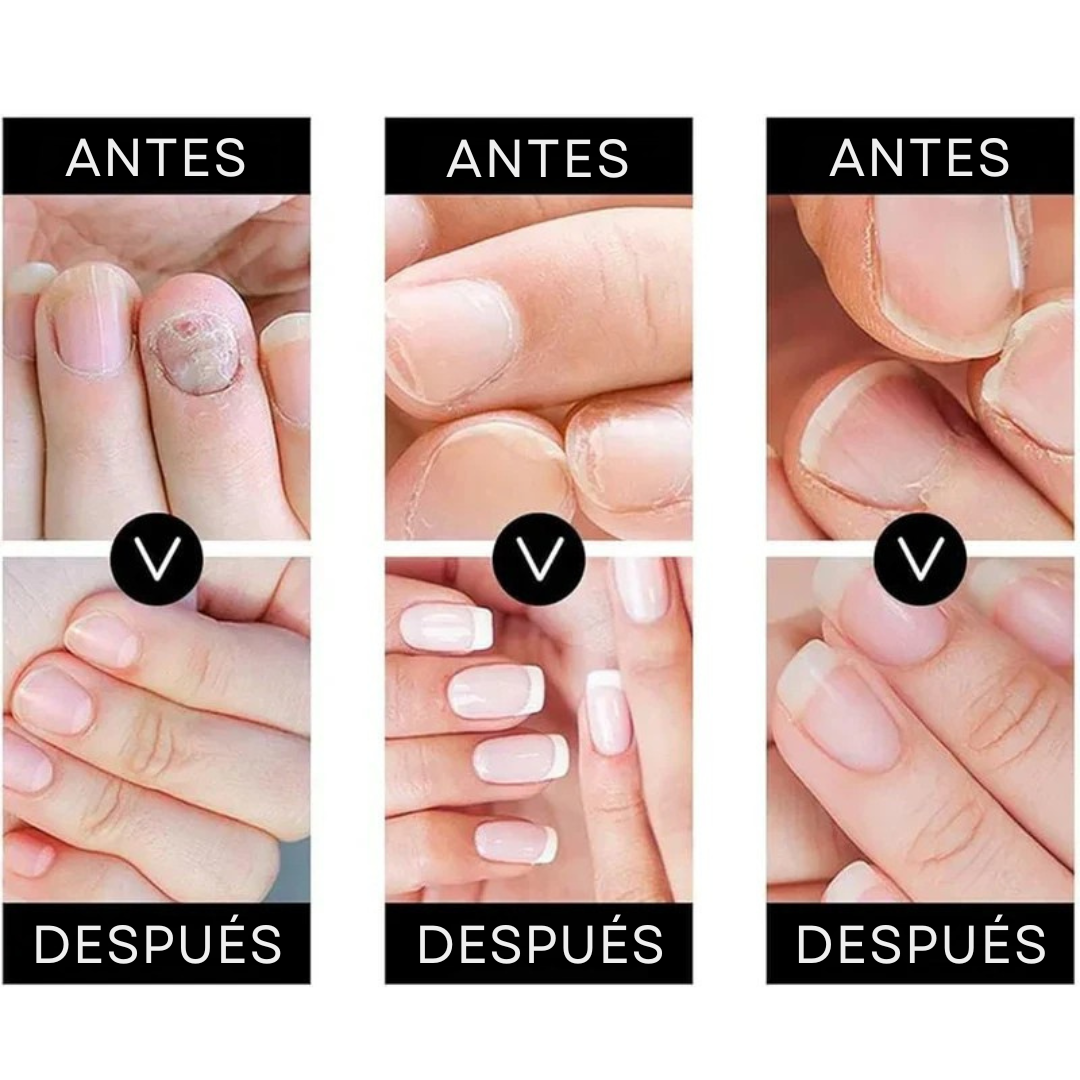 SERUM ELMINADOR DE HONGOS