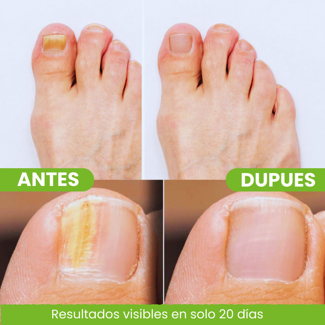 Fungivex Oil | Elimina el 99.9% de las infecciones por hongos de forma rápida y eficaz