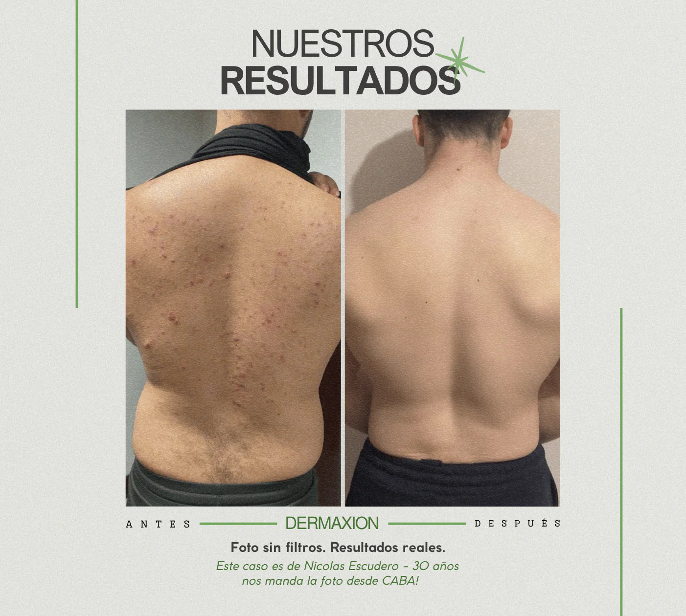 DermaXion® Gel Exfoliante Anti-Acné Pro