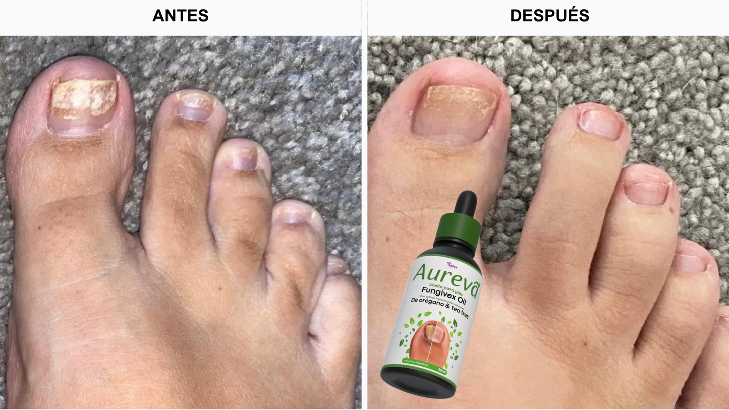Aureva™ Fungivex Oil – Tratamiento para Hongos + ¡Promo 2x1 por Tiempo Limitado