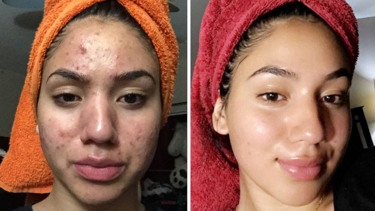 DermaXion® Gel Exfoliante Anti-Acné Pro