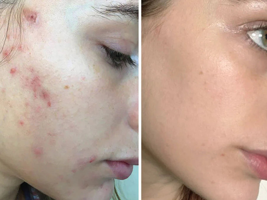DermaXion® Gel Exfoliante Anti-Acné Pro