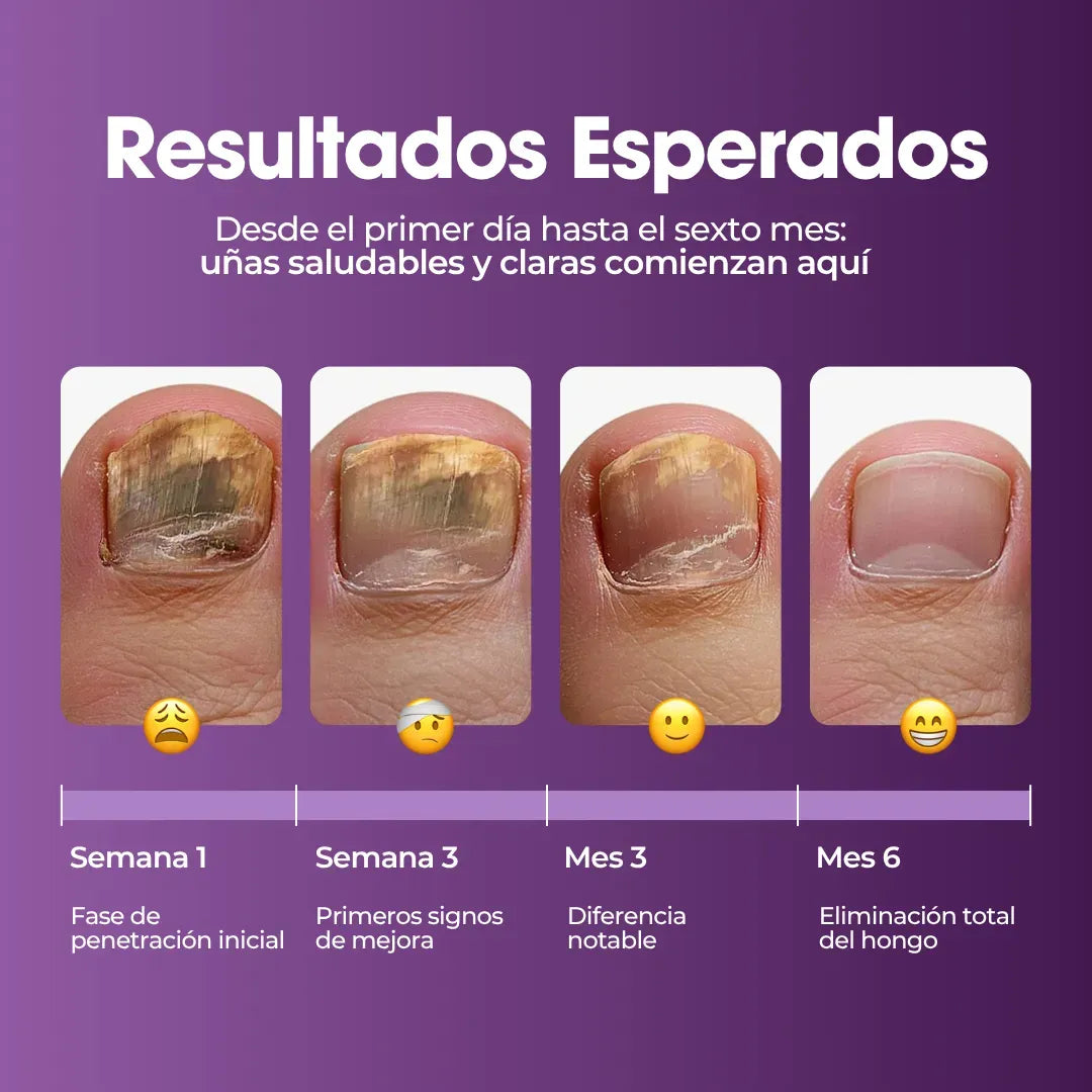 Aureva™ Fungivex Oil – Tratamiento para Hongos + ¡Promo 2x1 por Tiempo Limitado