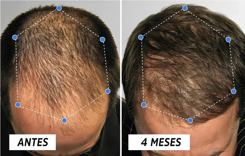 OUHOE Hair Elixir – Recupera tu Cabello Naturalmente