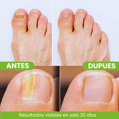 Fungivex Oil | Elimina el 99.9% de las infecciones por hongos de forma rápida y eficaz