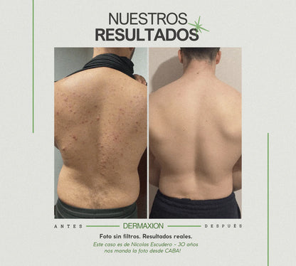 DermaXion® Gel Exfoliante Anti-Acné Pro