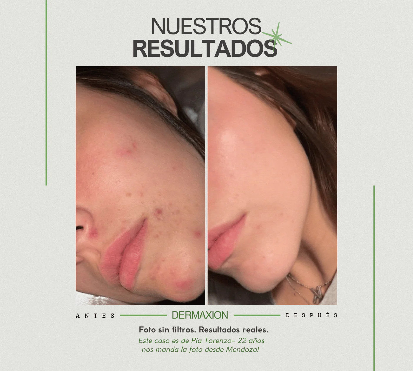 DermaXion® Gel Exfoliante Anti-Acné Pro
