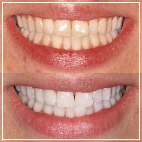 Smile White™ — El Lápiz Blanqueador 4X Más Potente (Promo 2x1)