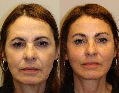 Vitagold - 20 AÑOS MENOS EN 5 MINUTOS