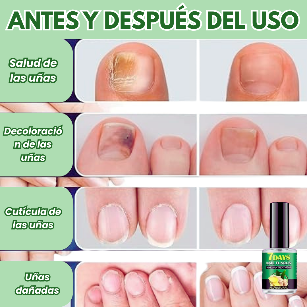 Tratamiento para los hongos en las uñas