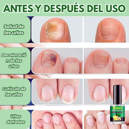 Tratamiento para los hongos en las uñas