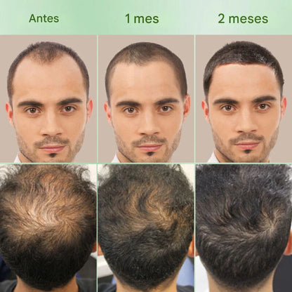 OUHOE Hair Elixir – Recupera tu Cabello Naturalmente