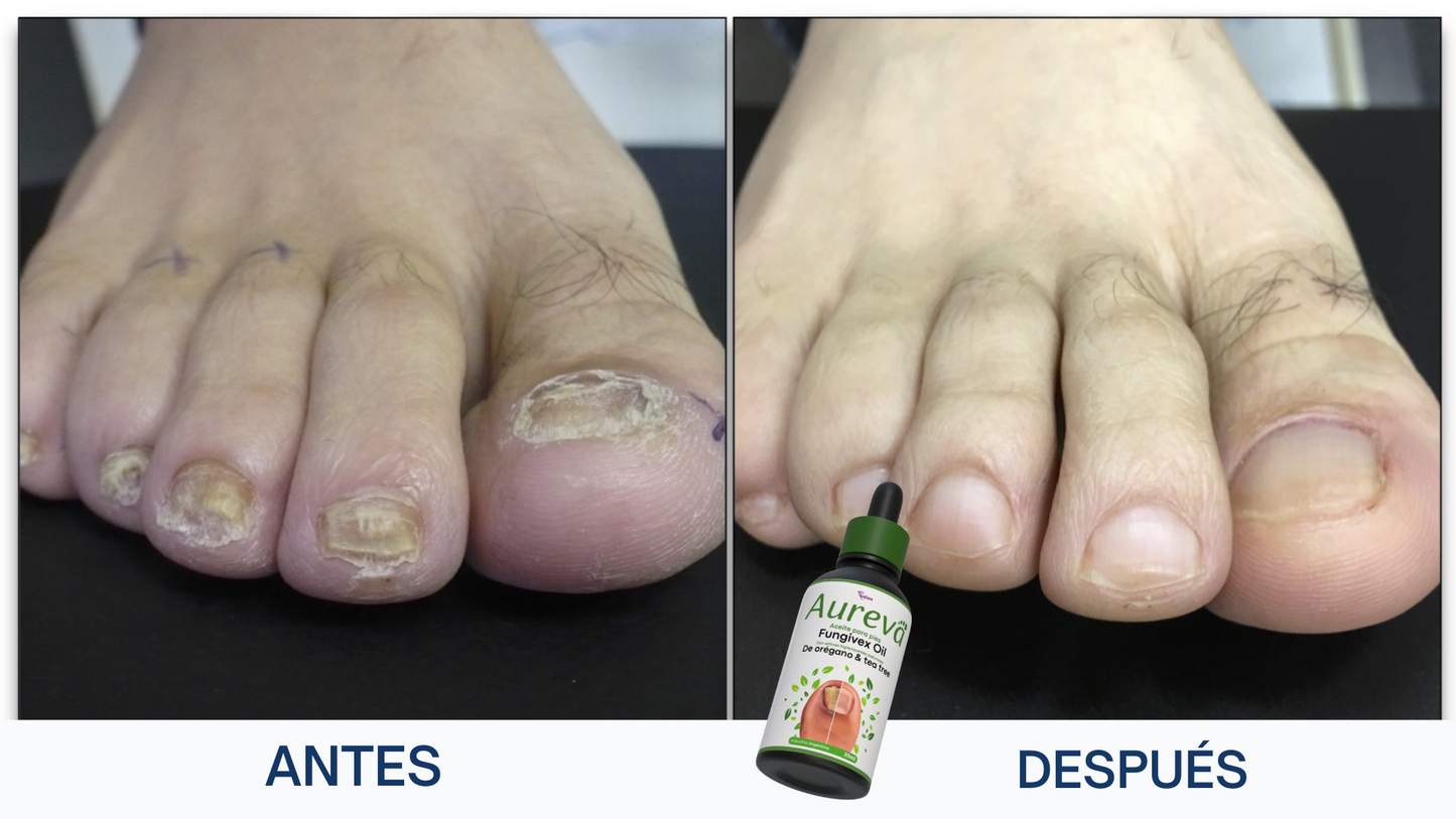 Aureva™ Fungivex Oil – Tratamiento para Hongos + ¡Promo 2x1 por Tiempo Limitado