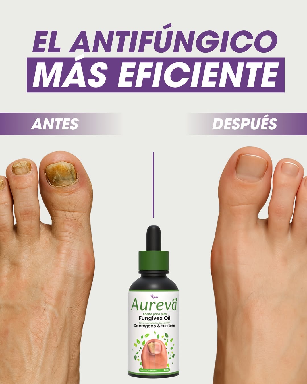 Fungivex Oil | El unico aceite que elimina el 99.9% de tus hongos.