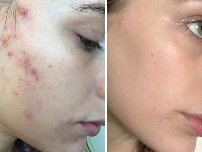 DermaXion® Gel Exfoliante Anti-Acné Pro