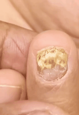 Tratamiento para los hongos en las uñas