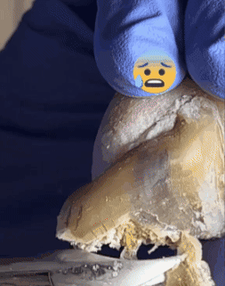 Tratamiento para los hongos en las uñas