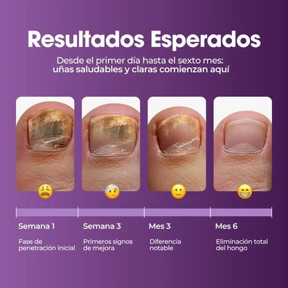 Aureva™ Fungivex Oil – Tratamiento para Hongos + ¡Promo 2x1 por Tiempo Limitado