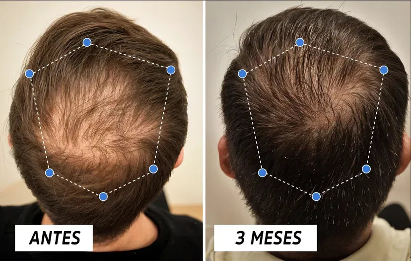 OUHOE Hair Elixir – Recupera tu Cabello Naturalmente
