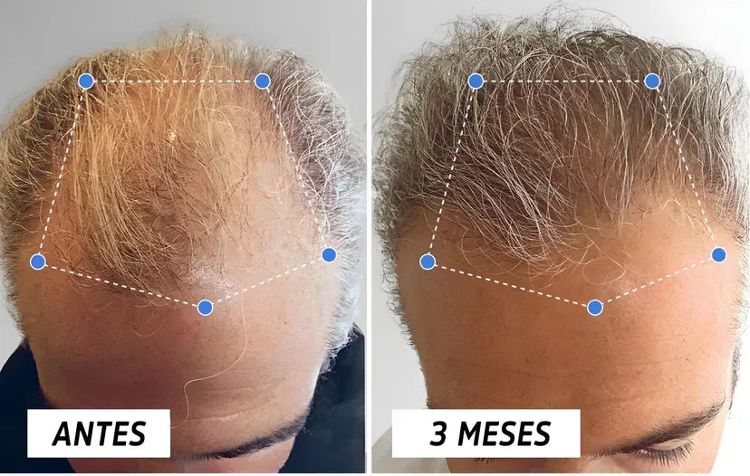 OUHOE Hair Elixir – Recupera tu Cabello Naturalmente