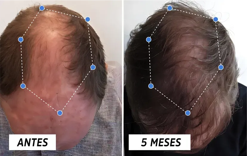 OUHOE Hair Elixir – Recupera tu Cabello Naturalmente